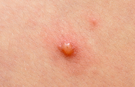 Molluscum contagiosum 474