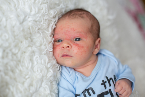 Baby acne 474