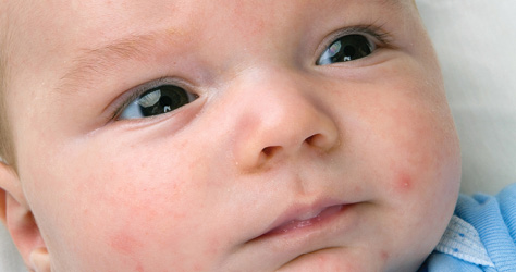 common-baby-skin-conditions