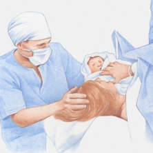 Woman having a c section